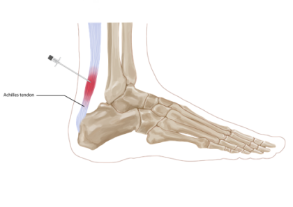 Achilles tendon injection opt