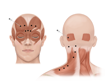 Botox for Migraine injection opt