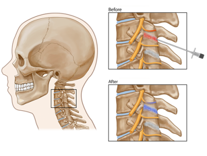 Cervical Facet Joint Injection opt