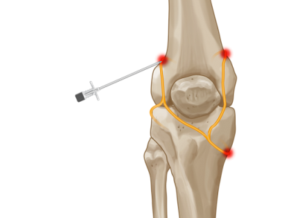 Cool RF knee opt