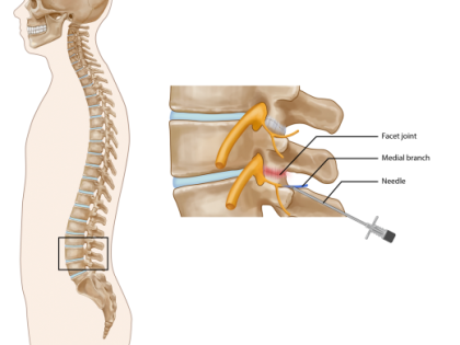 Lumbar Facet Radiofrequency Denervation opt 1