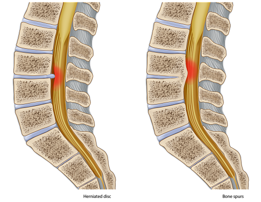 Spinal stenosis opt