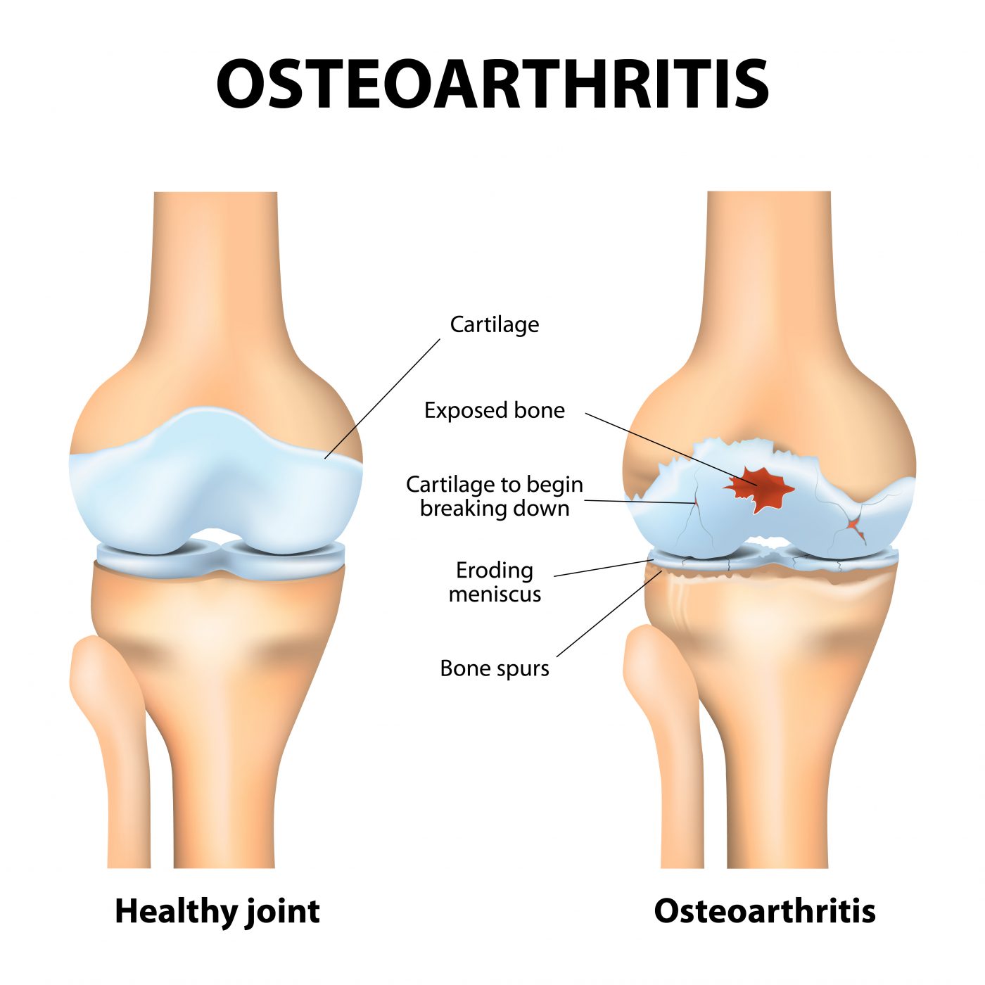knee joint pain treatment inject vitamin b12 Gel Injections | Non-Surgical Knee PRP Knee Injection | Knee