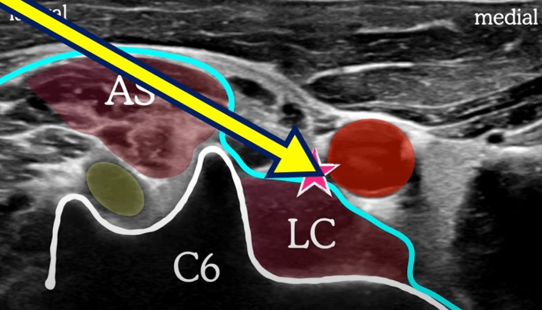 Stelate Injection Stellate Ganglion Block | Vascular & Visceral Pain Treatment | Pain Spa ...