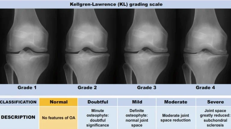 Normal Knee vs Osteoarthritis 1024x572