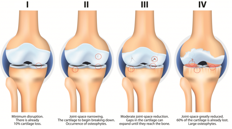 Stages of Knee Osteoarthritis 1024x571