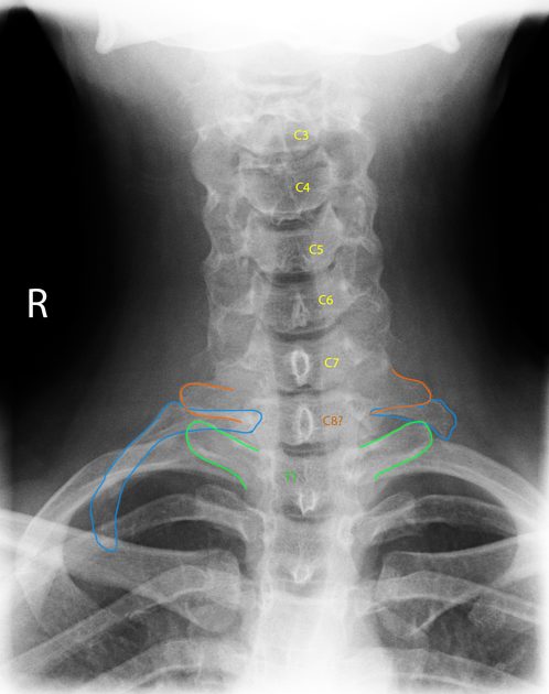 cervical rib