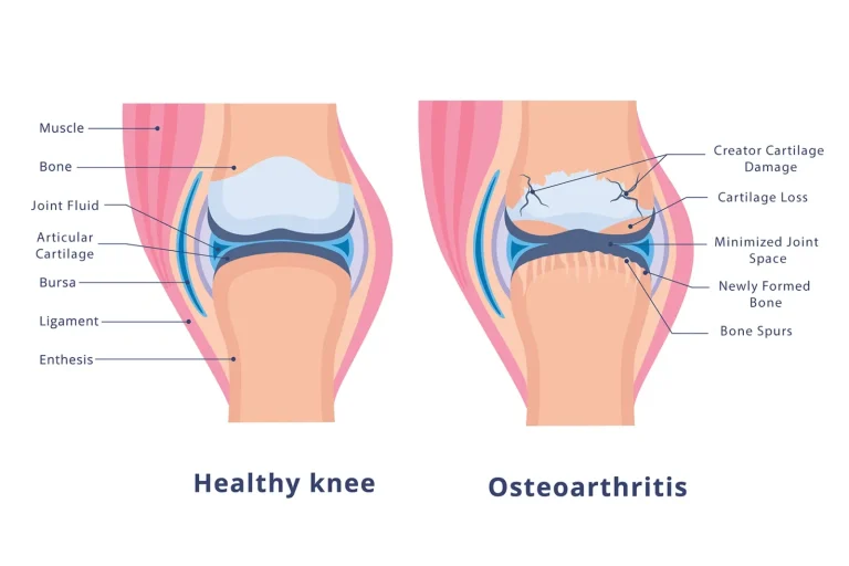 knee osteoarthritis seed