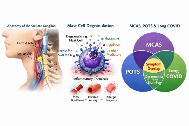 MCAS Stellate ganglion