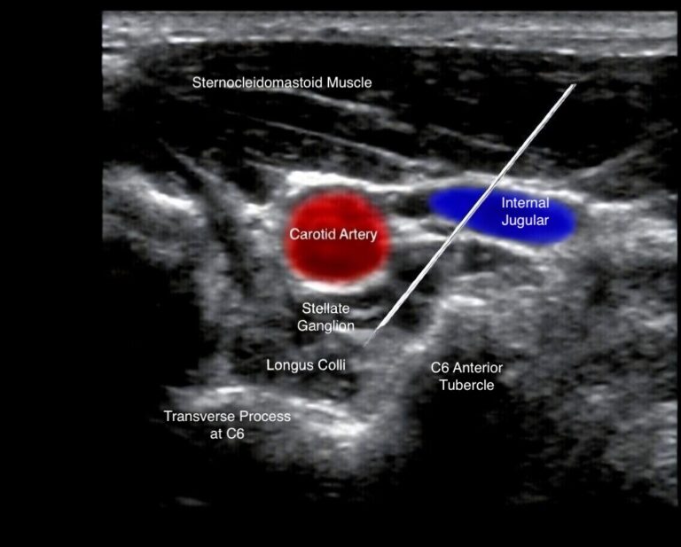 Stellate Ganglion ultrasound