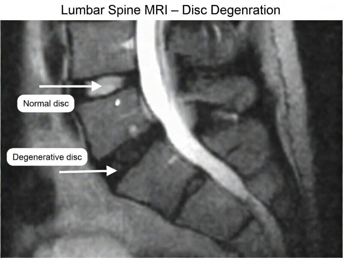 Discogenic Low Back Pain: Understanding the Cause and the Treatments ...