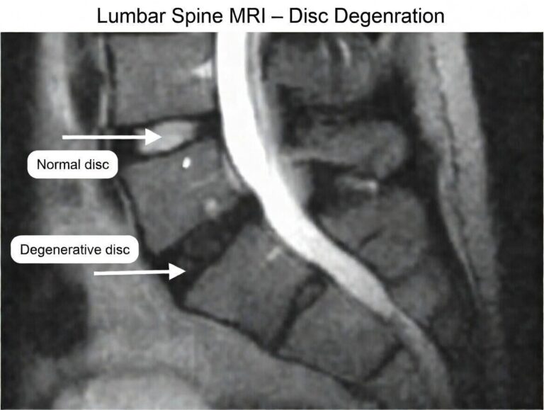 lumbar MRI